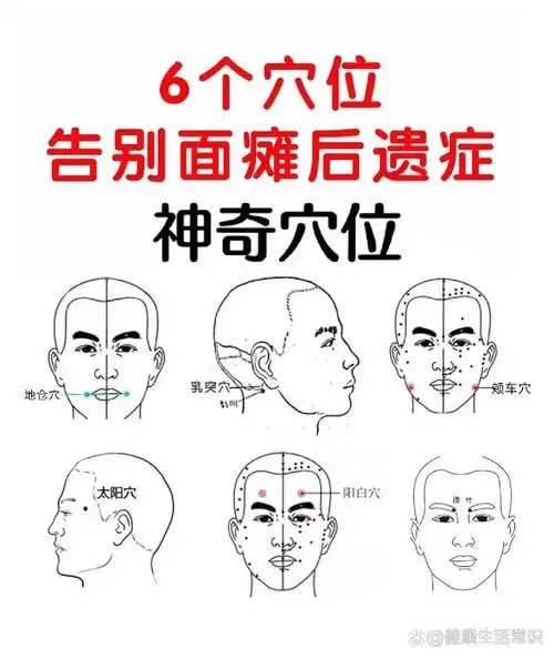 面瘫针灸康复