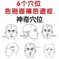 面瘫针灸康复